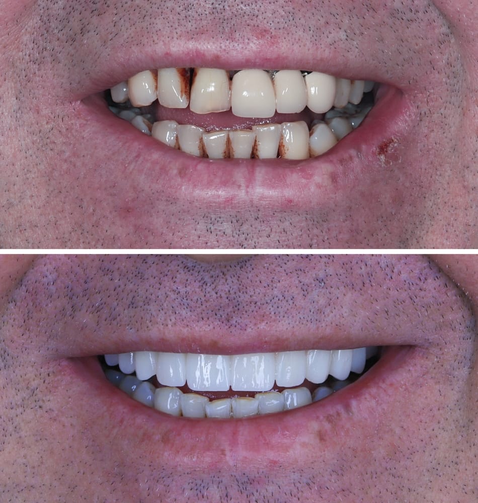 İzmir implant tedavisi uygulama durumları – HBADent