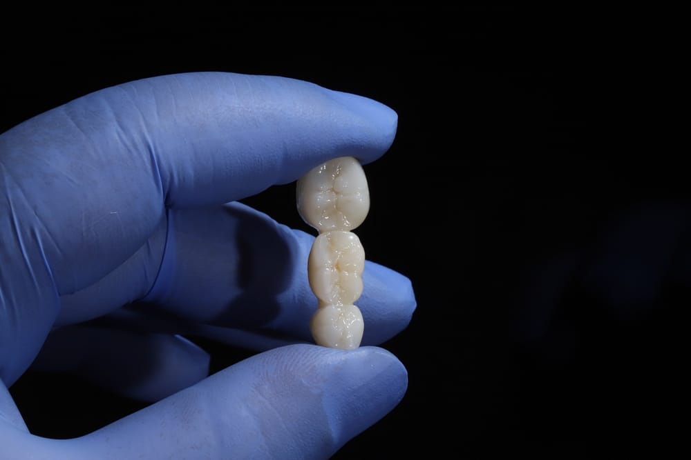 Urla diş kliniğinde zirkonyum kaplama tedavi süreci ve estetik sonuç