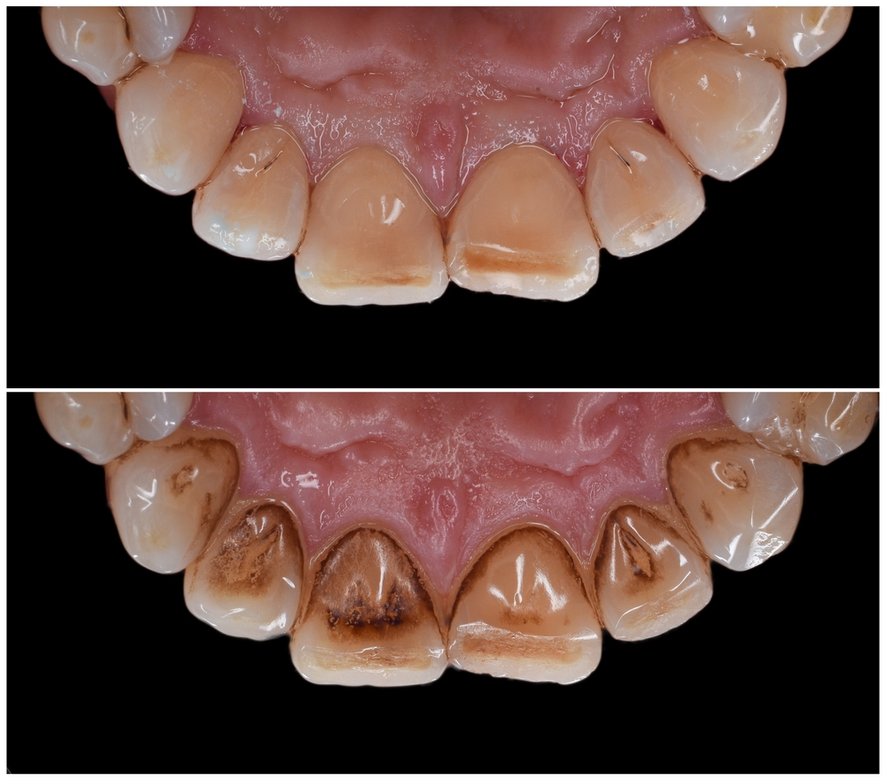 Diş taşı neden olur ve nasıl temizlenir?