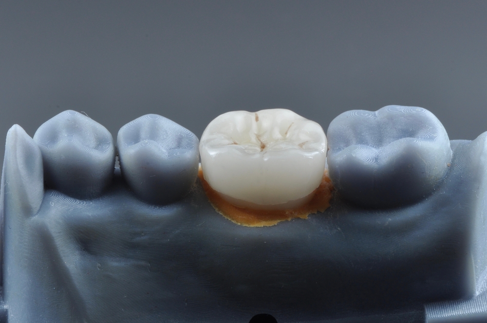 Diş dolgusu düşmesi nedenleri