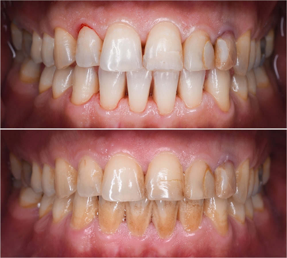 Diş taşı temizliği acıtır mı?