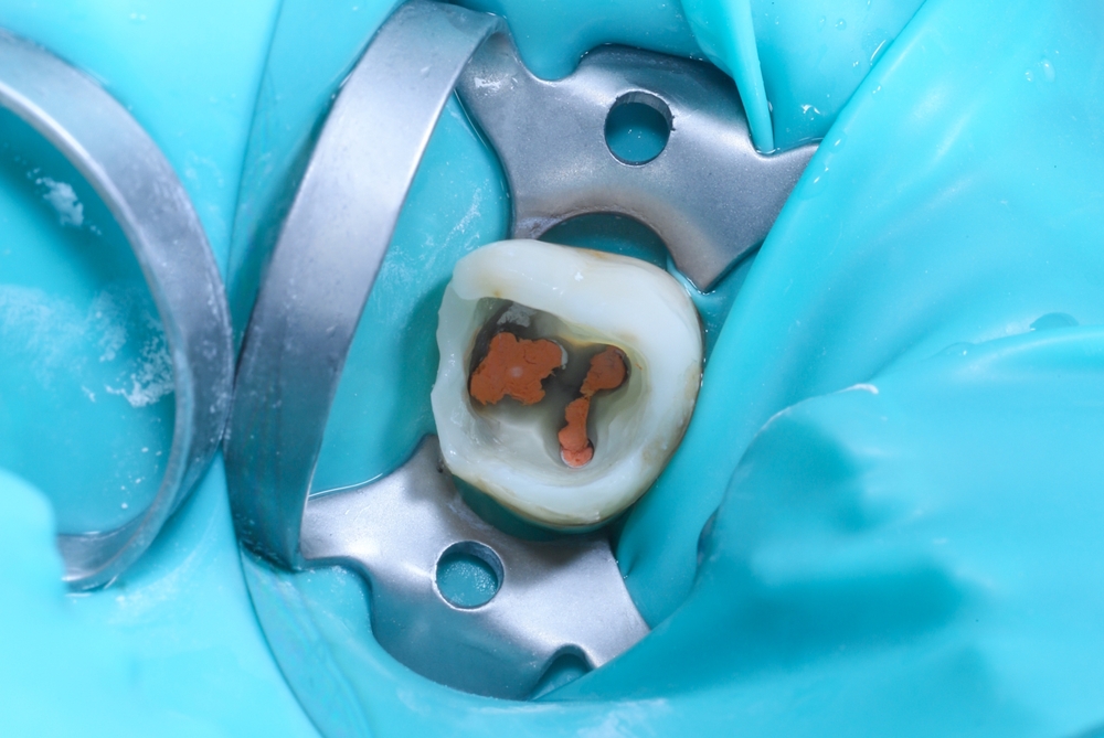 Kanal tedavisi sonrası bakım